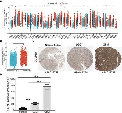 DUSP10 upregulation is a poor prognosticator and promotes cell proliferation and migration in glioma